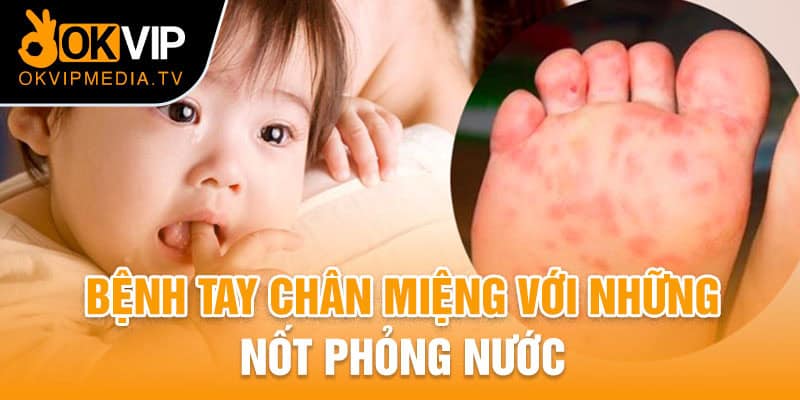 Bệnh nhân tay chân miệng với những nốt phỏng nước